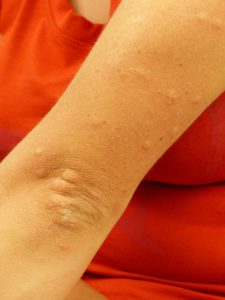 Das hilft gegen lästige Mücken und Juckreiz nach Stichen 2 (c) Pixabay.com
